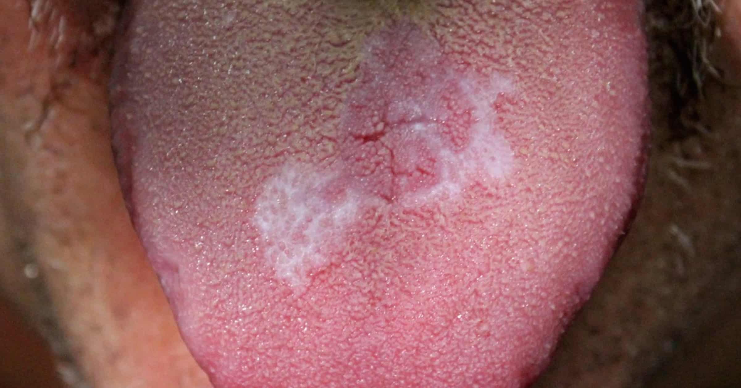 picture of oral lichen planus on a male tongue